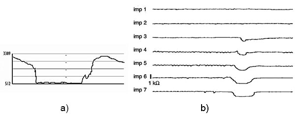 Рис. 11. Импедансная кривая (а), показывающая жидкий болюс: снижение импеданса более, чем на 50% относительно базальной линии. Импедансные кривые (b), отражающие жидкий рефлюкс в пищевод: чашеобразное снижение кривой начинается с дистальных каналов и прогрессирует в проксимальном