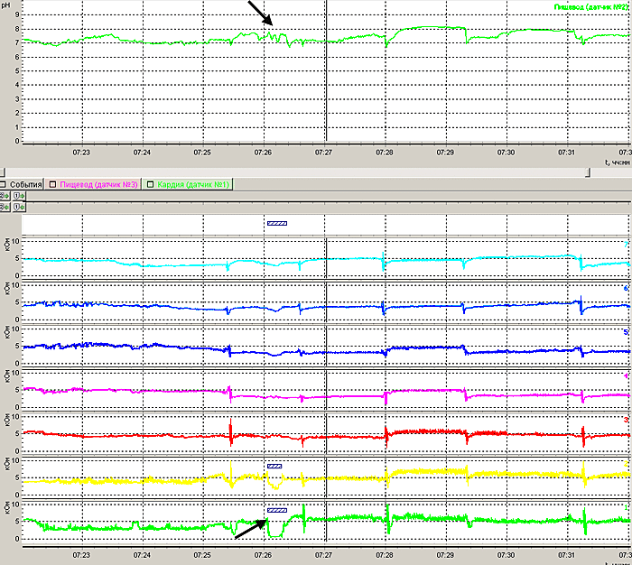 График рН-импедансометрии с эпизодом слабощелочного жидкого рефлюкса