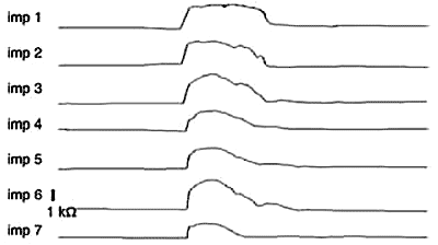 Импедансная кривая, отражающая эпизод супрагастральной отрыжки: газ, попадающий в пищевод при глотке, достигнув дистального канала, сразу же направляется в проксимальном направлении