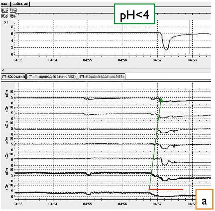 Fig. II. Combined impedance-pH recordings allows to identify the three types of reflux: a) Liquid acid reflux: retrograde drop in impedance starting distally together with a pH fall below 4