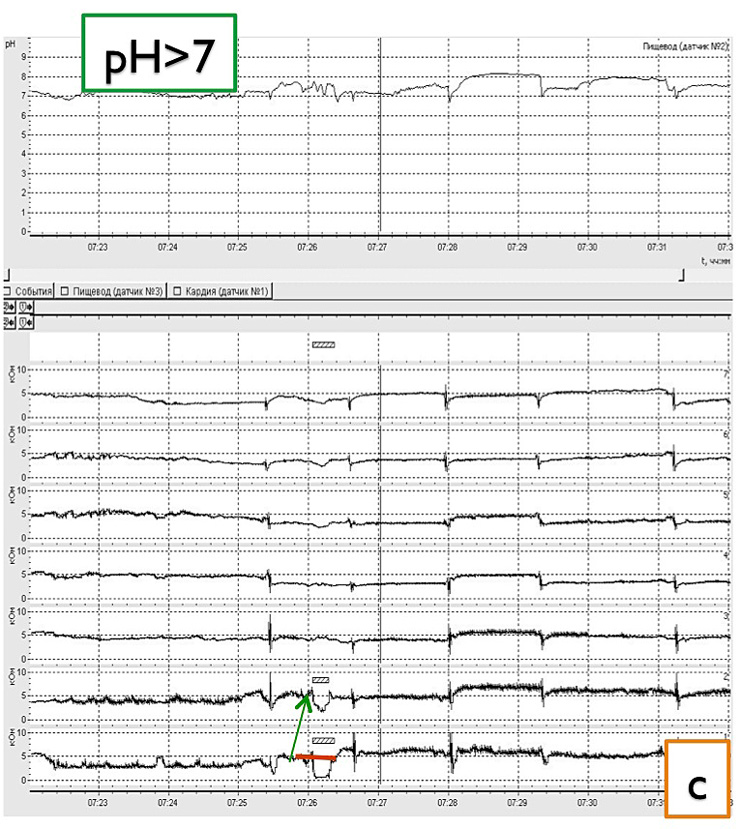 Fig. II. Combined impedance-pH recordings allows to identify the three types of reflux: c) Liquid alkaline reflux: retrograde drop in impedance starting distally with pH values above 7