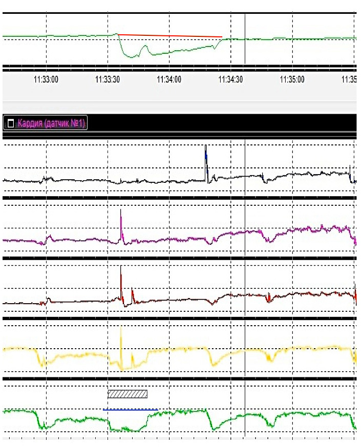 Fig. III. Chemical (red line) and volume (blue line) clearance time in ERD (left picture) and NERD (right picture) patients