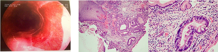 Fig. III. Endoscopic changes indicating Barrett's esophagus with histologic presence of esophageal intestinal metaplasia in DGER patient