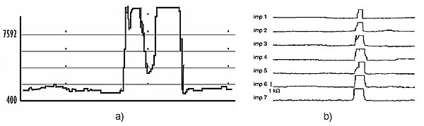 Рис. 13. Импедансная кривая (а), отражающая появление газового болюса: быстрое возрастание импеданса с абсолютным значением более 7000 Ом. Импедансные кривые (b), отражающие появление газового рефлюкса (отрыжки)